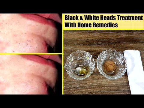 Homemade Face Mask for BlackHeads & WhiteHeads to Remove in Urdu Hindi