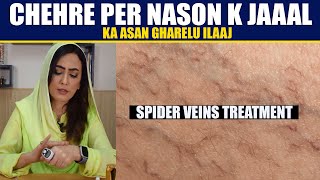 Dr. Umme Raheel Spider Veins Treatment at Home | Varicose Veins Herbal Treatment