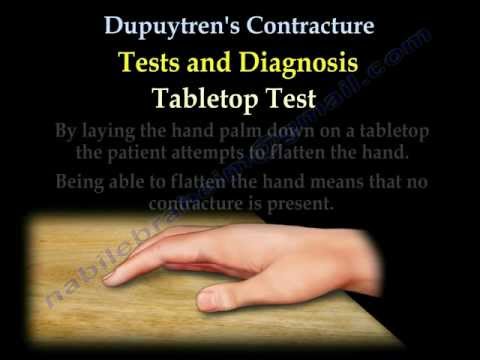 Dupuytren's Contracture - Everything You Need To Know - Dr. Nabil Ebraheim