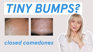 Why those tiny bumps AREN’T fungal acne!