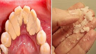 How to get rid of plaque home remedies for plaque and tartar