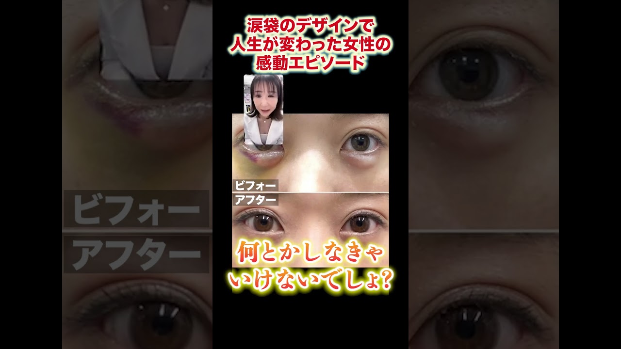 【切り抜き】涙袋のデザインで人生が変わった女性の感動エピソード#shorts #しのぶ皮膚科 #ヒアルロン酸 #美容医療 #美容 #美容整形