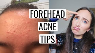 How To Get Rid Of FOREHEAD ACNE 🙌🏻