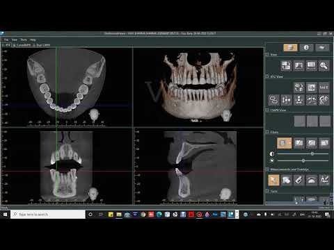 Morita i Dixel OneVolumenViewer Tutorial en ingles