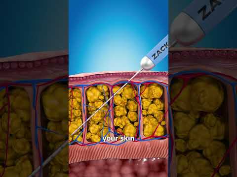 How Liposuction Works 💉🤔