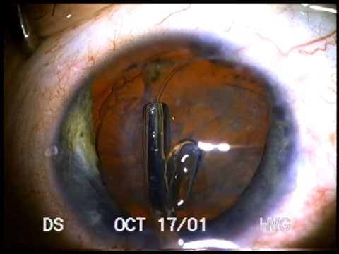 Traumatic Cataract: BB Gun Pellet