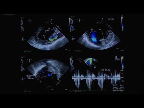 20180821_9_ Pulmonary and Tricuspid valves_ C_Kumar_Dr