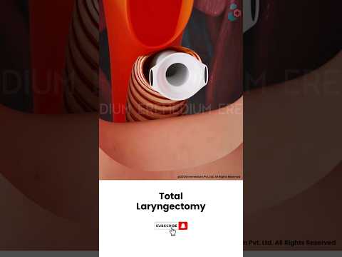 Laryngectomy: Throat Cancer Surgery ↪ 3D Medical Animation #Shorts #Laryngectomy #Throat #Surgery