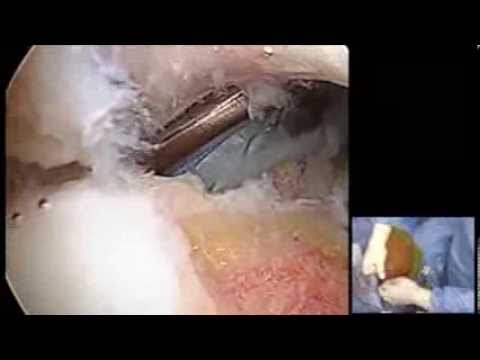 comment soigner rupture coiffe rotateurs
