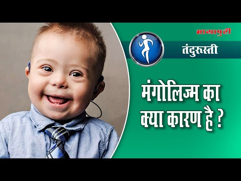 Mongolism Explained !! Down Syndrome Children in Hindi | Tandrusti Dr. Baldeep Singh