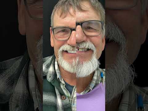 Real Patient Stories Dental Treatment in Los Algodones Mexico at Dental Place Clinic