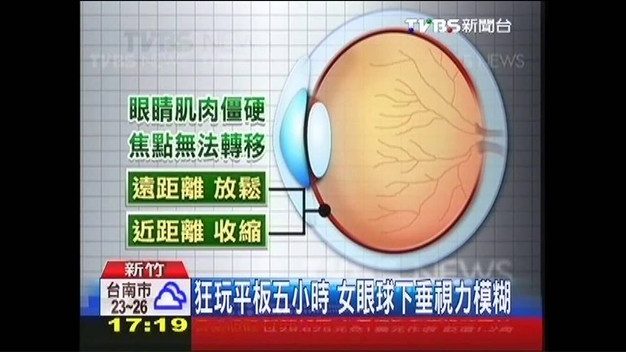 狂玩平板5小時 女眼球下垂、視力模糊