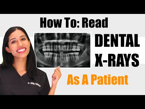 How to Read Dental X-rays? (As a patient) | Dr. Mihika
