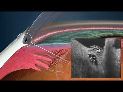 iStent-Flujo del humor acuoso a través de la malla trabecular