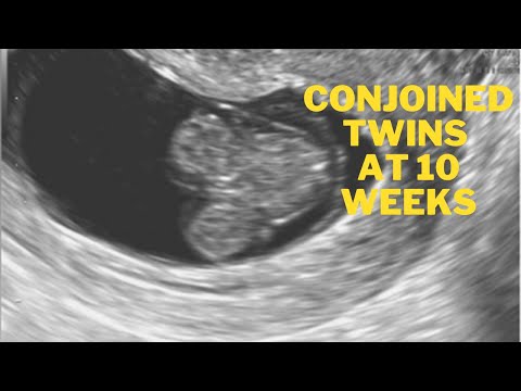 Ultrasound Video Showing Conjoined twins at 10 weeks