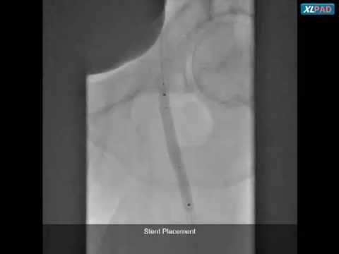 Viance, Subintimal Re-entry, and Stenting for Mid SFA CTO