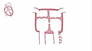 Ventricular septal defect VSD   repair, causes, symptoms & pathology
