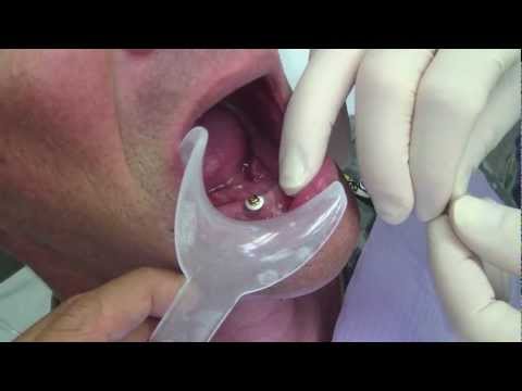 LOCATOR Attachment Pick-Up — Dr. Dray Demonstration