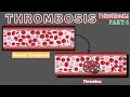 Unmasking Blood Clots The Hidden Dangers Of Thrombosis And Embolism