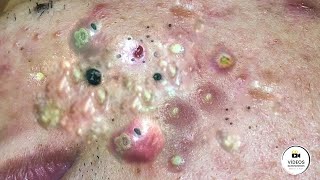 Espremendo Cravos Gigantes 😱 | Limpeza de Pele Profunda, Acne, Cravos e Espinhas–Muito Satisfatório!
