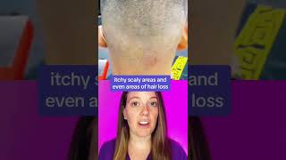 Fungal Infection of Scalp | Ringworm (Tinea Capitis)