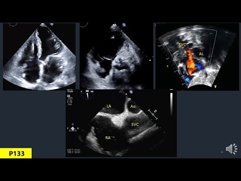 Anatomy Of Heart In Echo Part 6: Right Atrium