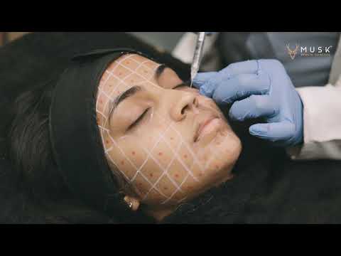 Juvederm Volite With Lidocaine Fillers