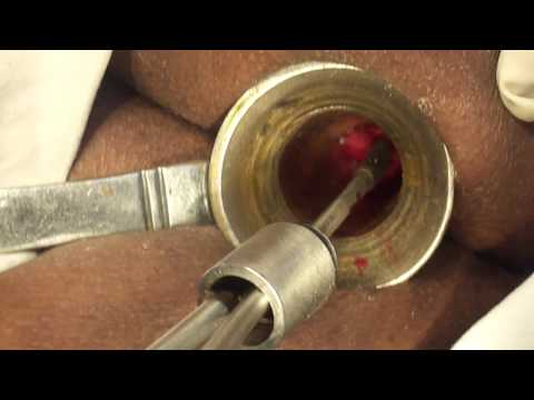 M4H015~12 bhopalsurgery1.mp4