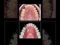 How to pull teeth underground when braces?