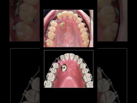 How to pull teeth underground when braces?