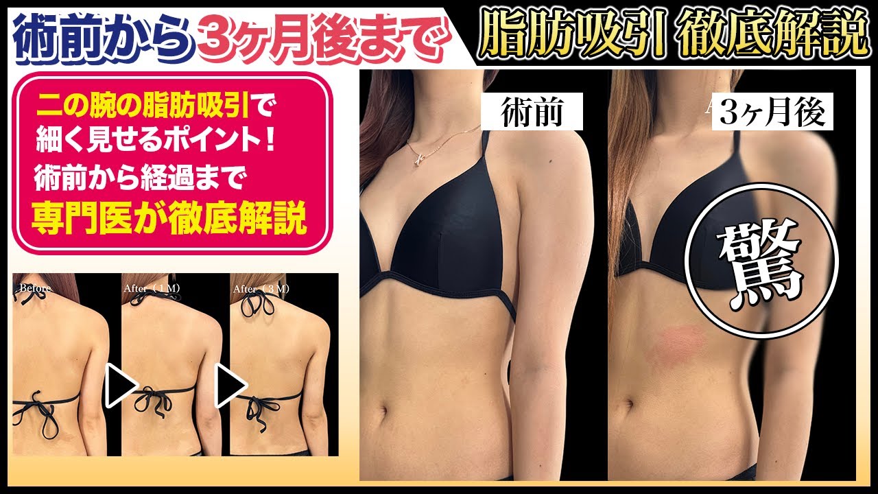 【二の腕脂肪吸引】18歳・アイスホッケー経験者｜筋肉質でも華奢になれる？700cc吸引のリアル経過