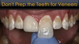 Don't Prep the Teeth for Veneers