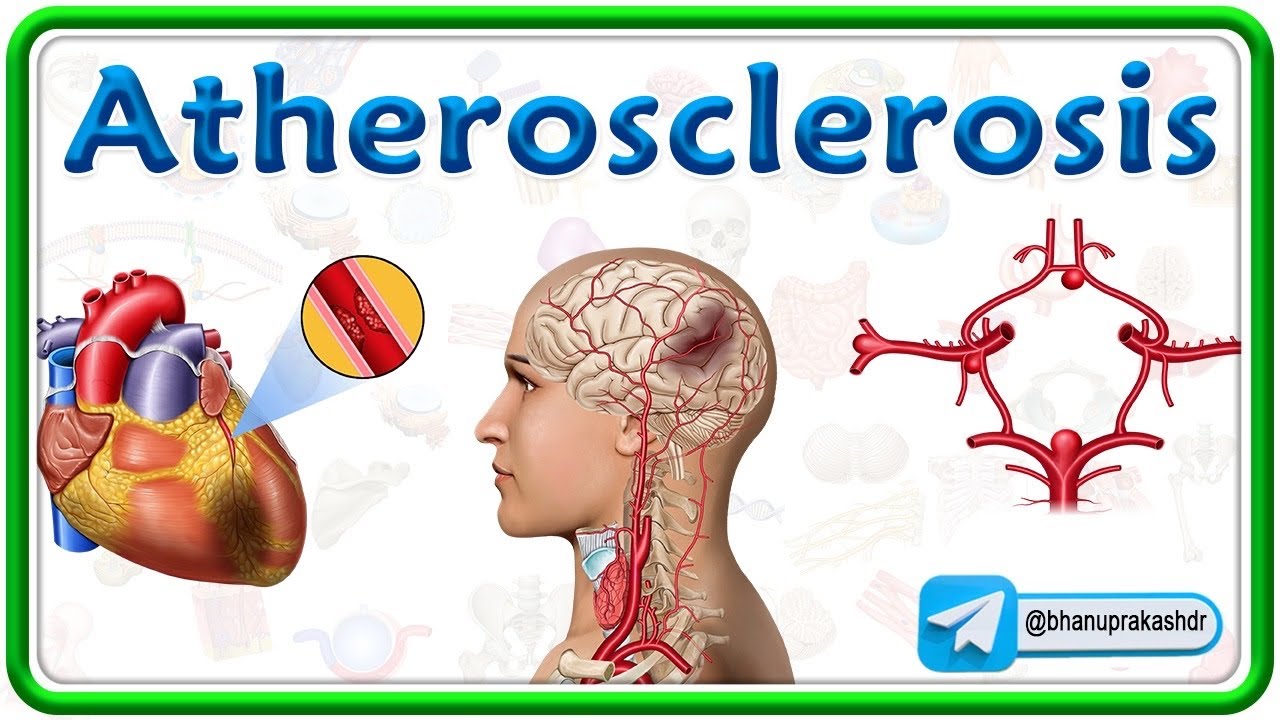 Atherosclerosis Pathology Animation: Causes, Pathogenesis, Risk factors, Complications: USMLE Step 1