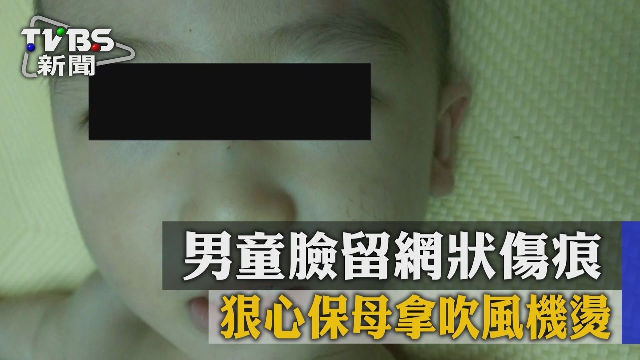 狠心保母拿吹風機燙　男童臉留網狀傷痕