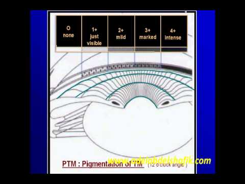 Gonioscopy Lecture Part 7