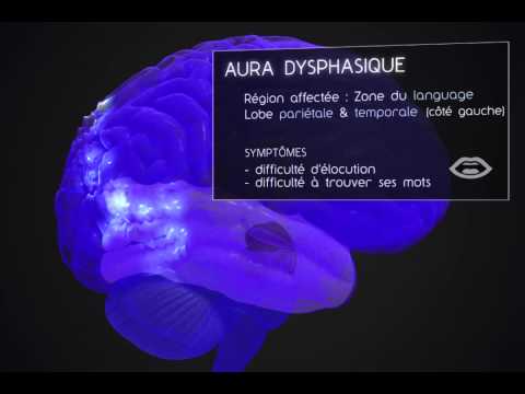 comment soulager migraine ophtalmique