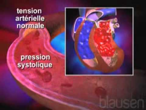 Tension basse Magnésium dans lhypertension