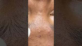 Hidden acne you can’t see from the surface 😅 #skincare #satisfying #blackheads #pimple