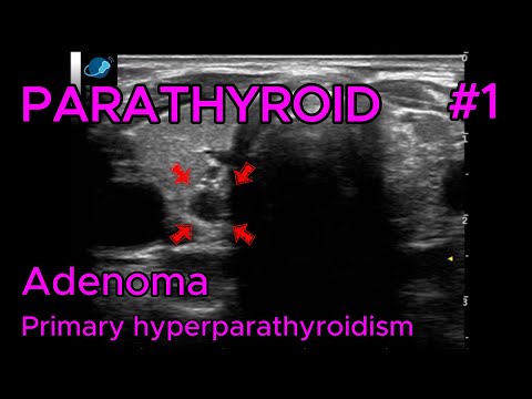 Adenoma (primary hyperparathyroidism) video preview
