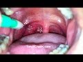 Tonsil Stone Removal - The WRONG Way! - YouTube