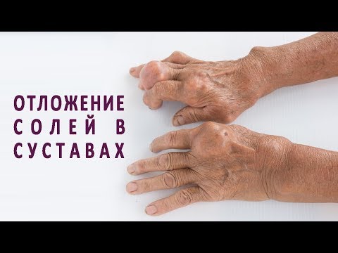 Спондилез шейного отдела и его симптомы Боли в правой руке в плечевом суставе лечение