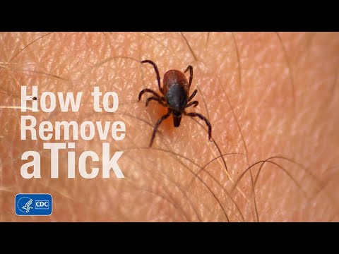 How to remove a tick