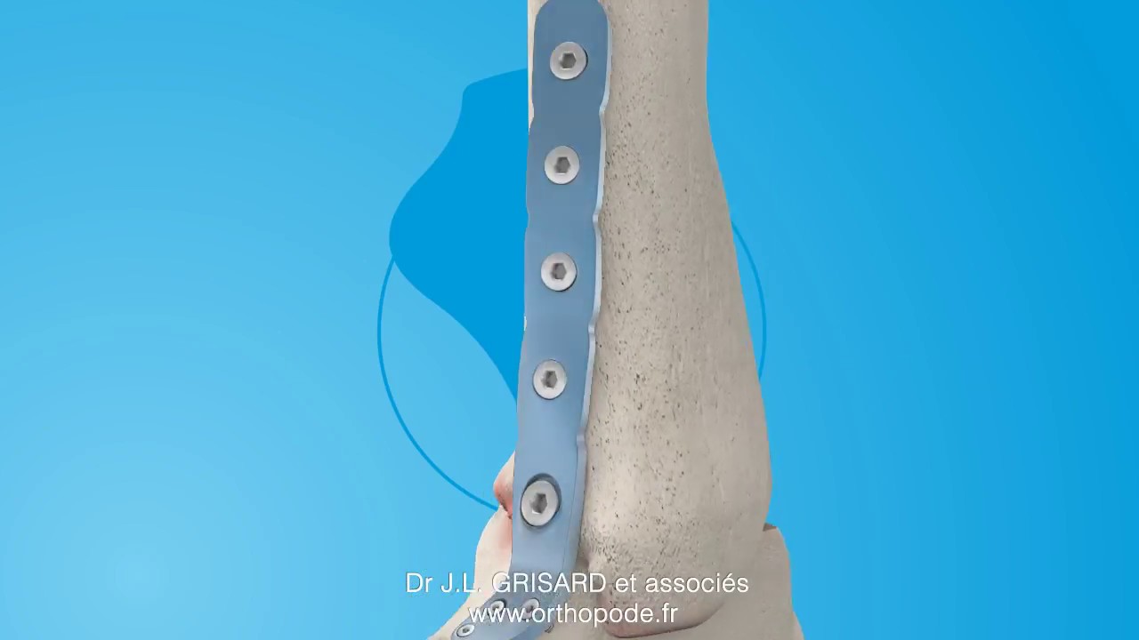 L'Arthrodèse de la Cheville