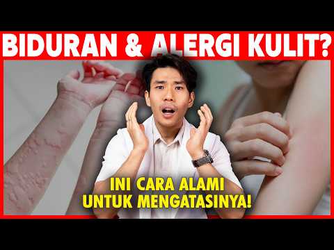 Cara Alami Mengatasi Biduran Dan Alergi Kulit
