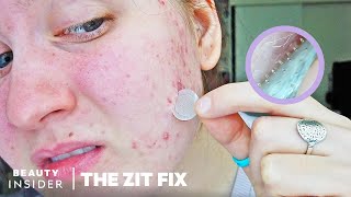 Microneedle Patch Works To Erase Acne Scars And Dark Spots | The Zit Fix