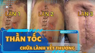 PLASMAMED: CHIẾU TIA PLASMA LẠNH CÔNG NGHỆ TIÊN TIẾN LÀNH THƯƠNG THẦN TỐC CHỈ SAU 3 LẦN CHIẾU
