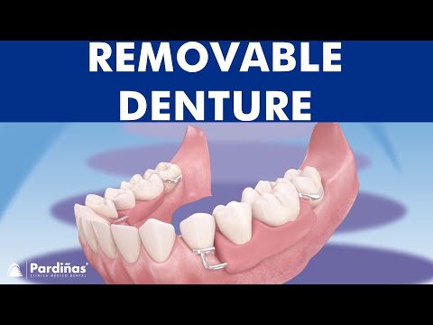 Removable partial denture ©