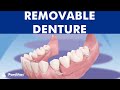 Removable Partial Denture
