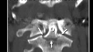 Descargar Podcast 11 Cervical Spine Trauma MP3. Podcast 11 Cervical Spine Trauma