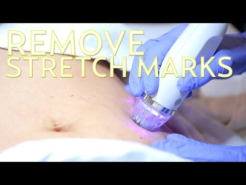 How to Get Rid of Stretch Marks with EndyMed | The SASS with Susan and Sharzad Video